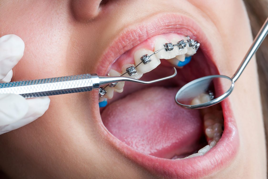 Invisalign and the Power of Personalised Orthodontics