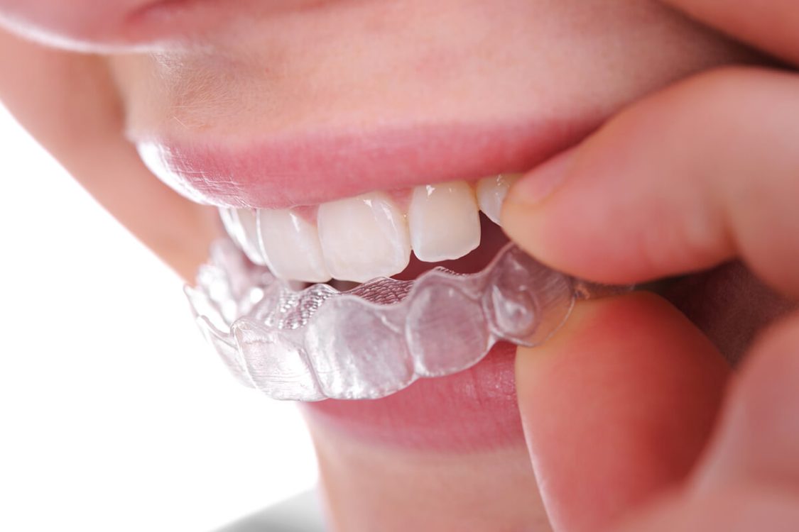 Unlocking Confidence: The Subtle Revolution of Invisalign